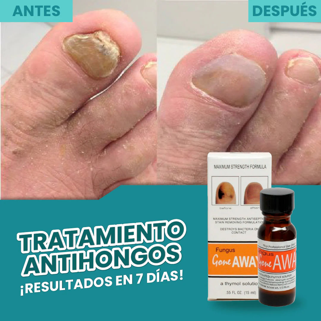 GOTERO PARA HONGOS EN LAS UÑAS